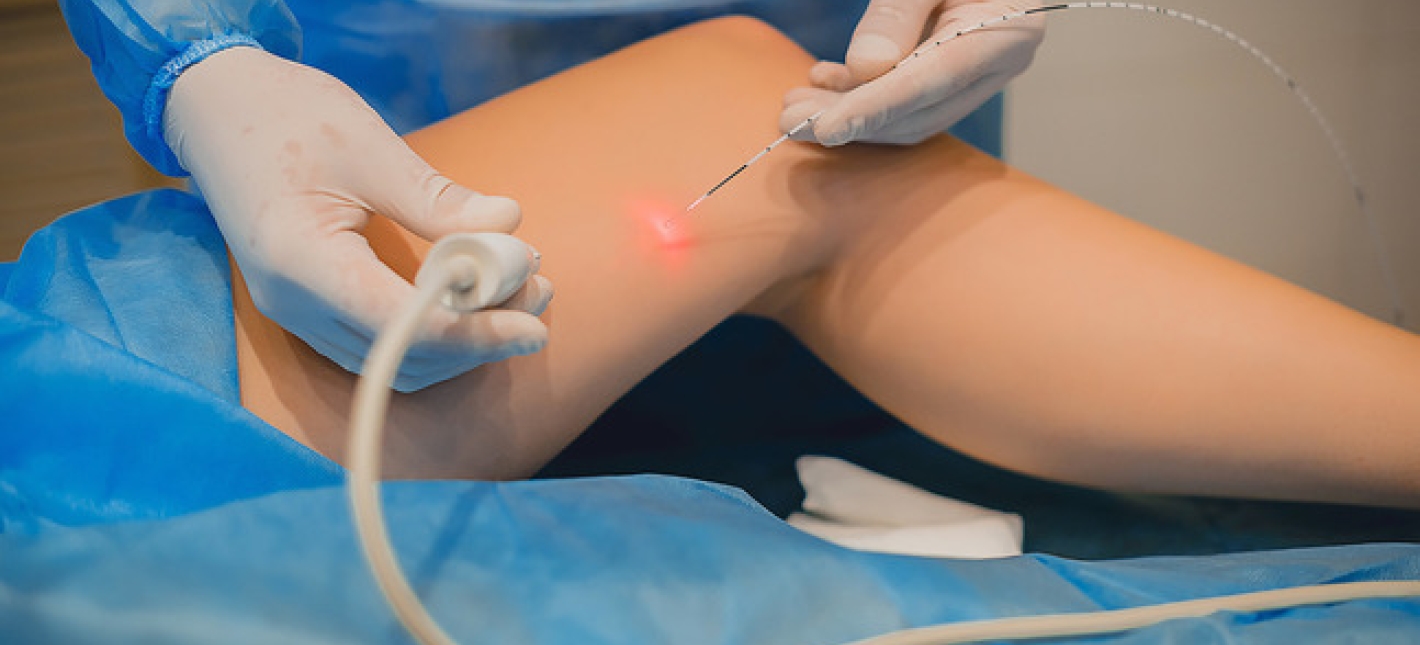 Эндовенозная лазерная коагуляция вен (ЭВЛК) 