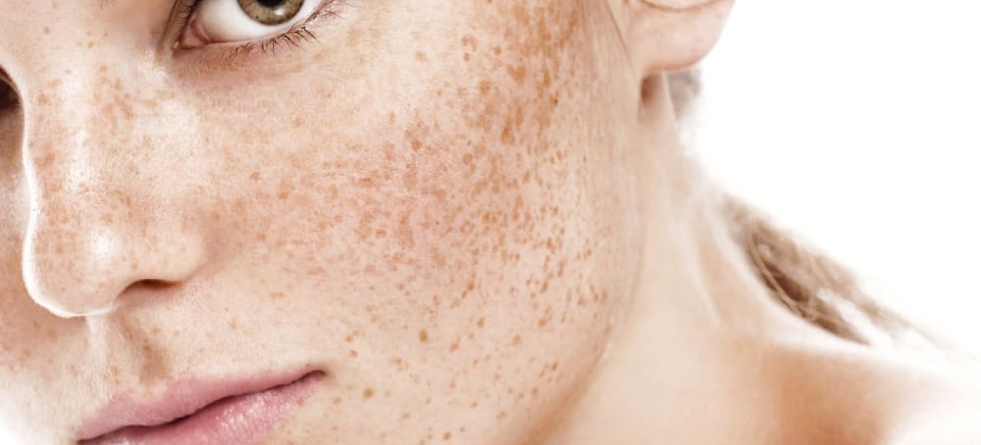 Фотолечение возрастных изменений (хлоазма, лентиго, возрастная пигментация) 