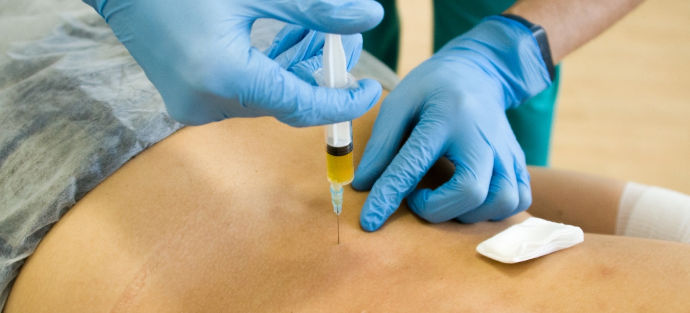 Плазмолифтинг (аутостимуляция регенераторных процессов с применением аутоплазмы, PRP-терапия)