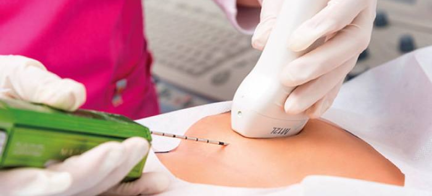 Лечебно-диагностическая пункция молочной железы