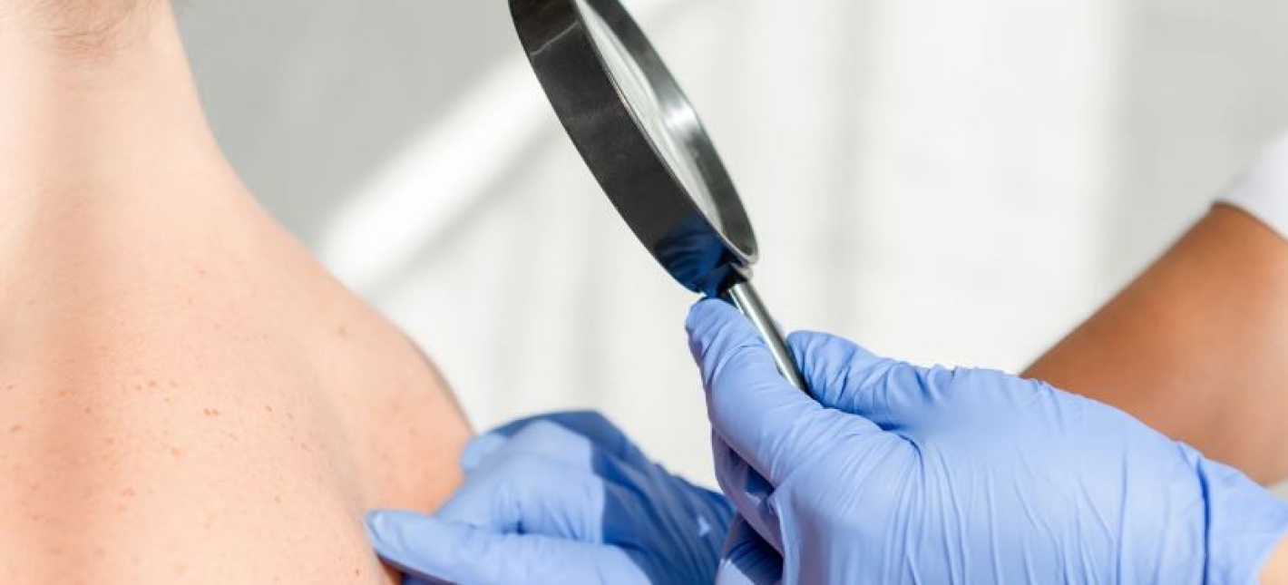 Консультация дерматолога